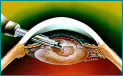 Phacoemulsification probe